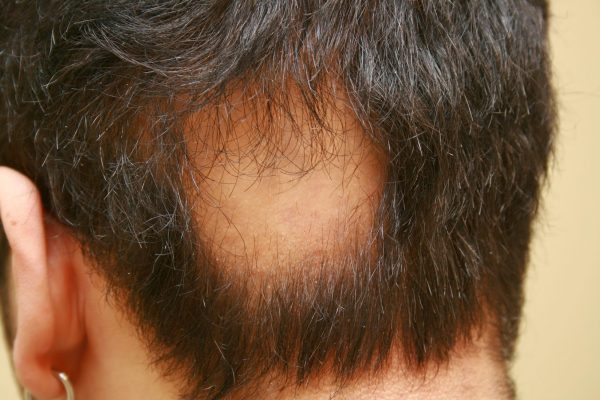 Quais-são-os-principais-tipos-de-alopecia-que-existem