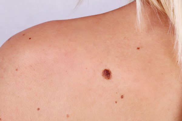 article_skincancer