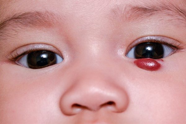 hemangioma-tumor-bebe-0519-1400x800